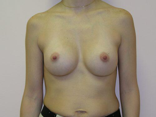 Breast Augmentation  Before & After Image