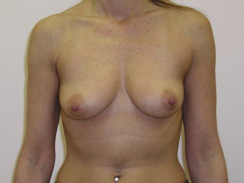 Breast Augmentation  Before & After Image