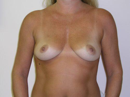 Breast Augmentation  Before & After Image