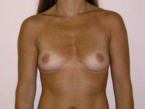 Breast Augmentation  Before & After Image