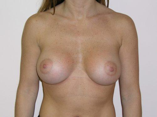 Breast Augmentation  Before & After Image