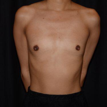 Breast Augmentation  Before & After Image