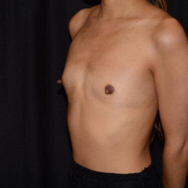 Breast Augmentation  Before & After Image