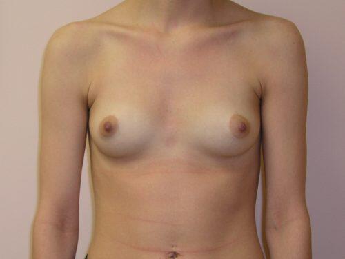 Breast Augmentation  Before & After Image