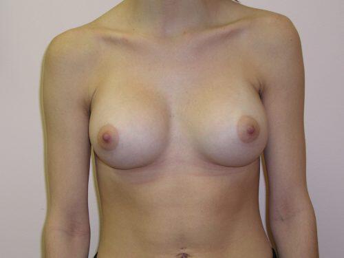 Breast Augmentation  Before & After Image