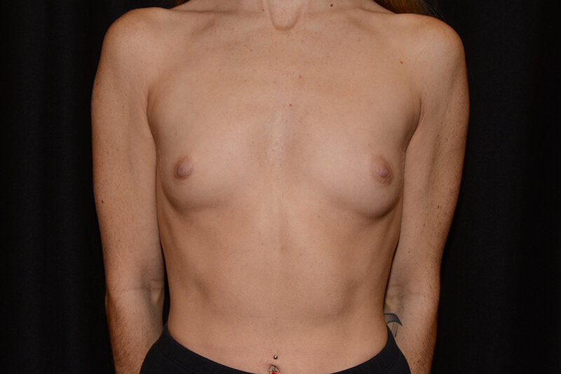 Breast Augmentation  Before & After Image