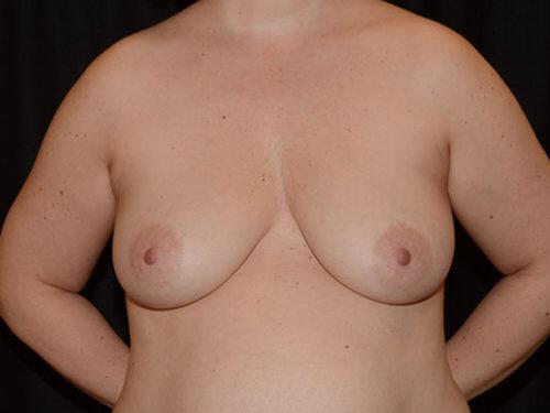 Breast Lift  Before & After Image