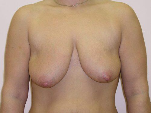 Breast Lift  Before & After Image