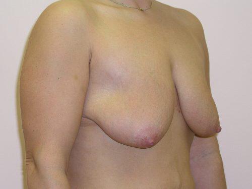 Breast Lift  Before & After Image