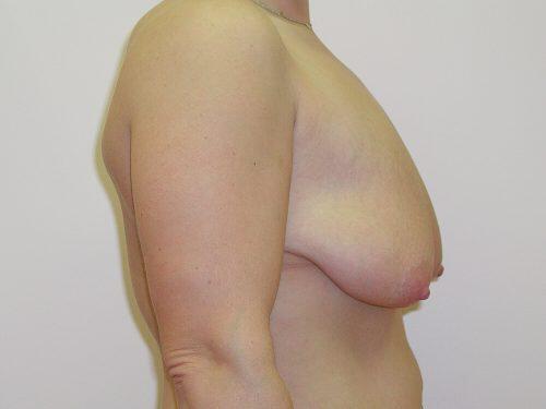 Breast Lift  Before & After Image