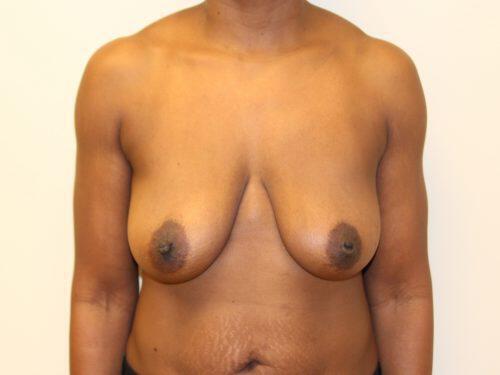 Breast Lift  Before & After Image