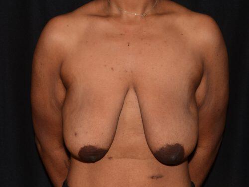 Breast Lift  Before & After Image