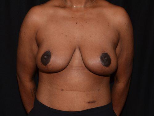 Breast Lift  Before & After Image