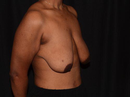 Breast Lift  Before & After Image