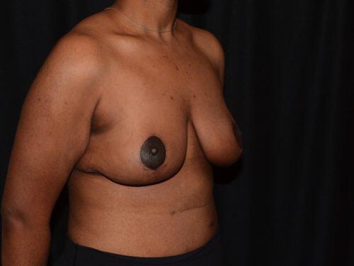 Breast Lift  Before & After Image