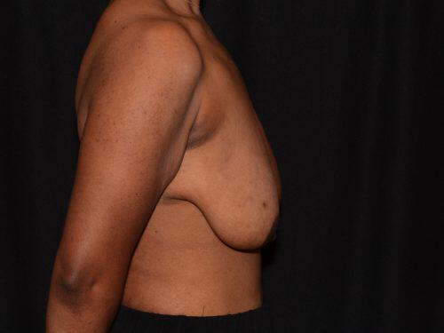 Breast Lift  Before & After Image