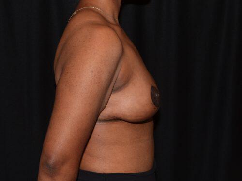 Breast Lift  Before & After Image