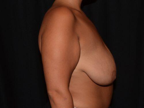 Breast Lift  Before & After Image