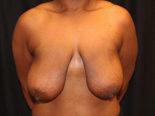 Breast Reduction  Before & After Image