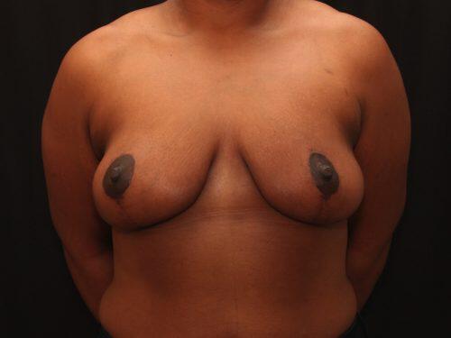 Breast Reduction  Before & After Image