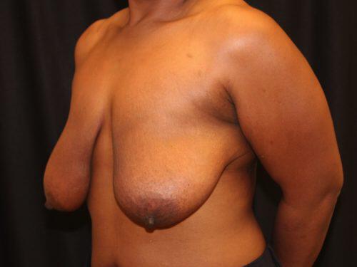 Breast Reduction  Before & After Image