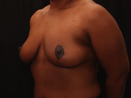 Breast Reduction  Before & After Image