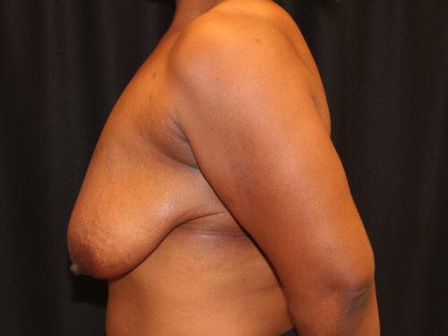 Breast Reduction  Before & After Image