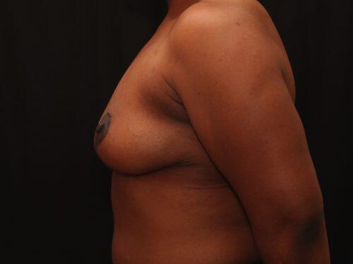 Breast Reduction  Before & After Image