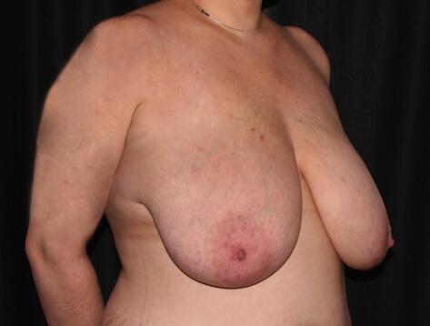 Breast Reduction  Before & After Image