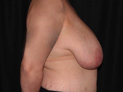 Breast Reduction  Before & After Image