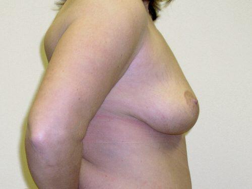 Breast Reduction  Before & After Image