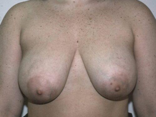 Breast Reduction  Before & After Image