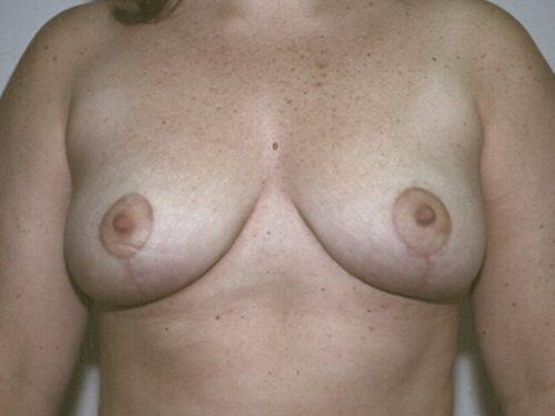 Breast Reduction  Before & After Image