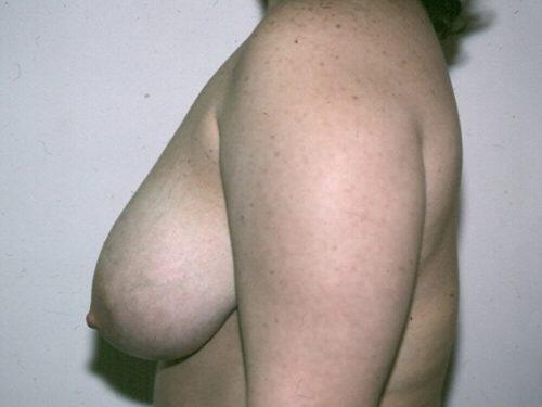 Breast Reduction  Before & After Image