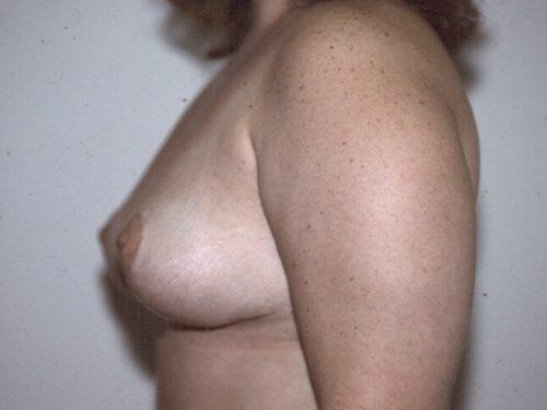 Breast Reduction  Before & After Image