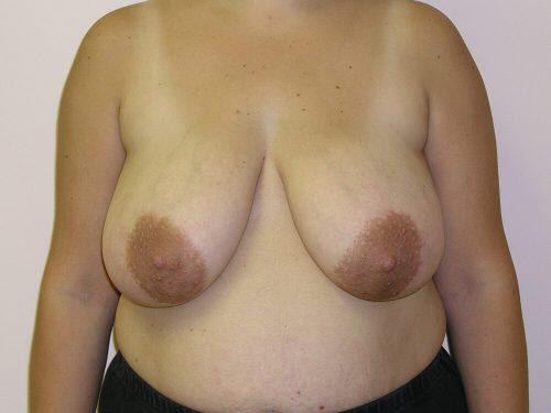 Breast Reduction  Before & After Image