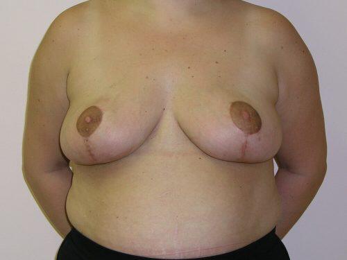 Breast Reduction  Before & After Image