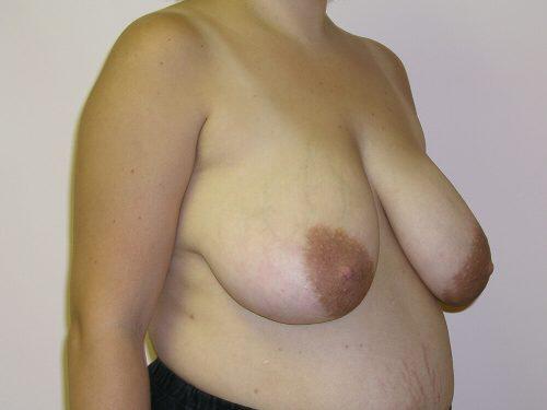 Breast Reduction  Before & After Image