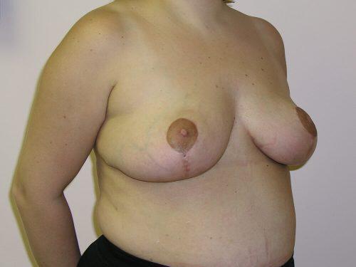 Breast Reduction  Before & After Image