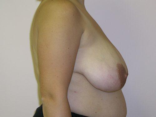 Breast Reduction  Before & After Image