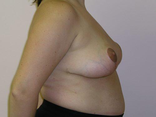 Breast Reduction  Before & After Image