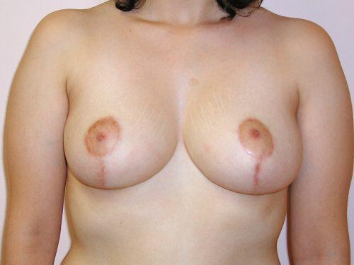 Breast Reduction  Before & After Image