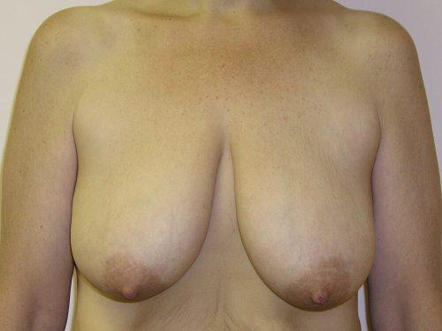 Breast Reduction  Before & After Image