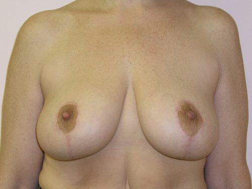 Breast Reduction  Before & After Image
