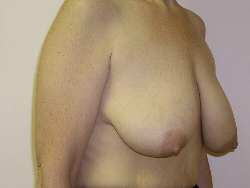 Breast Reduction  Before & After Image