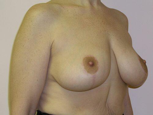 Breast Reduction  Before & After Image