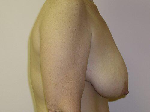 Breast Reduction  Before & After Image