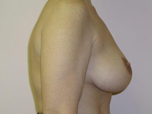 Breast Reduction  Before & After Image