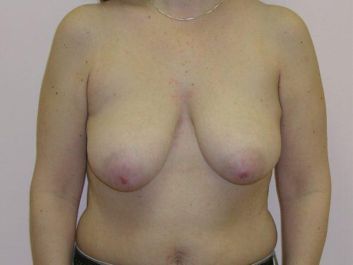 Breast Reduction  Before & After Image