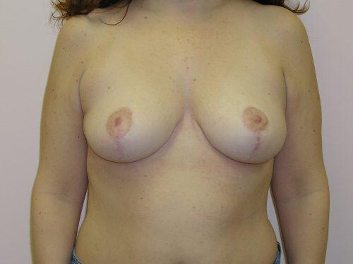 Breast Reduction  Before & After Image